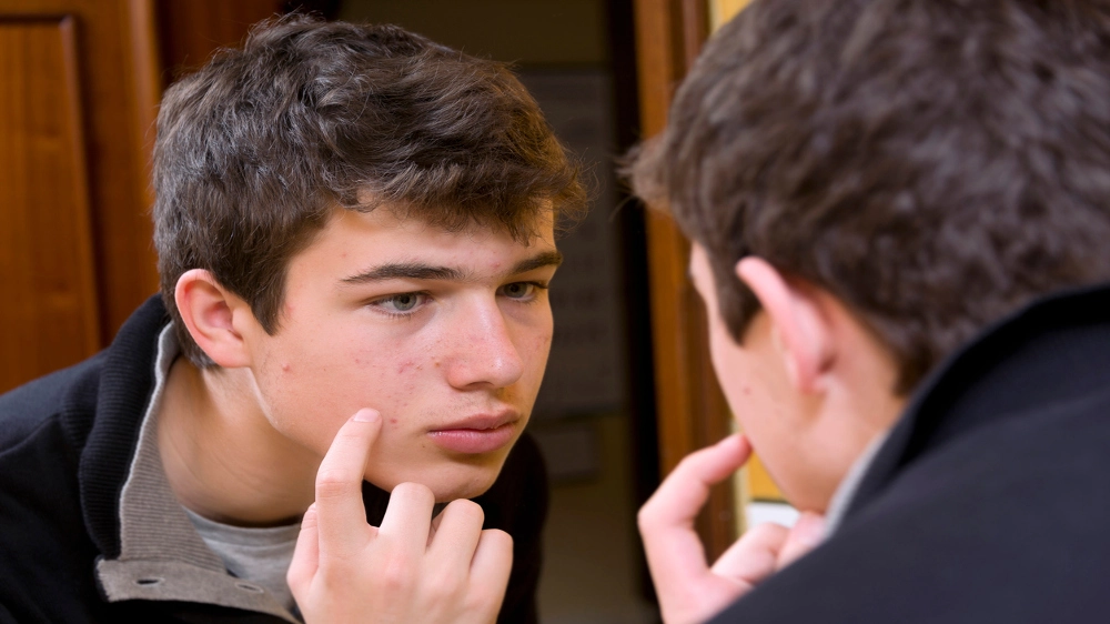 C'è una connessione tra acne e depressione - Foto: Syldavia/iStock 