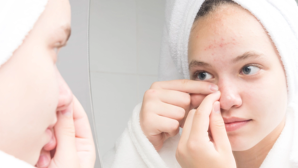 Macchie post-acne - Crediti iStock Photo