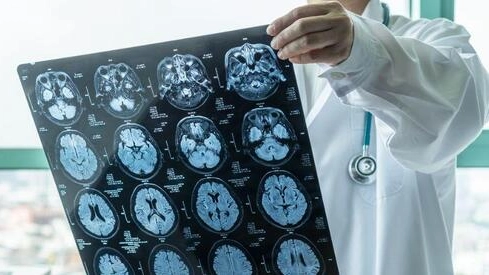 Alzheimer, scoperto un gene che provoca la malattia: “Forse una svolta nelle terapie”