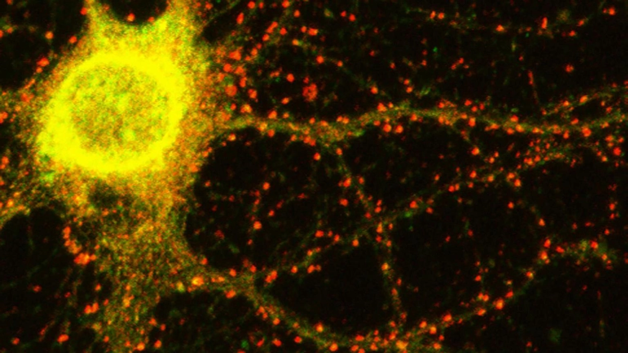 Il gene Grin2C, legato all'Alzheimer, scoperto da ricercatori italiani. Mutazioni rare e ruolo del glutammato studiati.